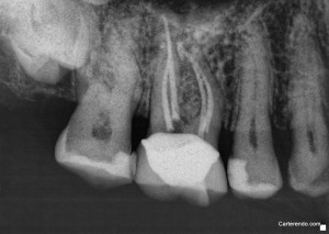 MS3distal